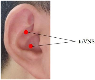 Altered functional connectivity of the thalamus in patients with insomnia disorder after transcutaneous auricular vagus nerve stimulation therapy
